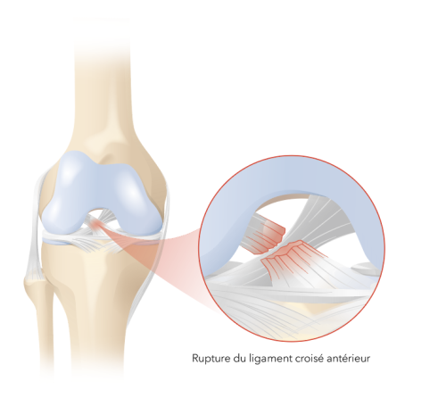 Illustration expliquant une rupture du ligament croisé