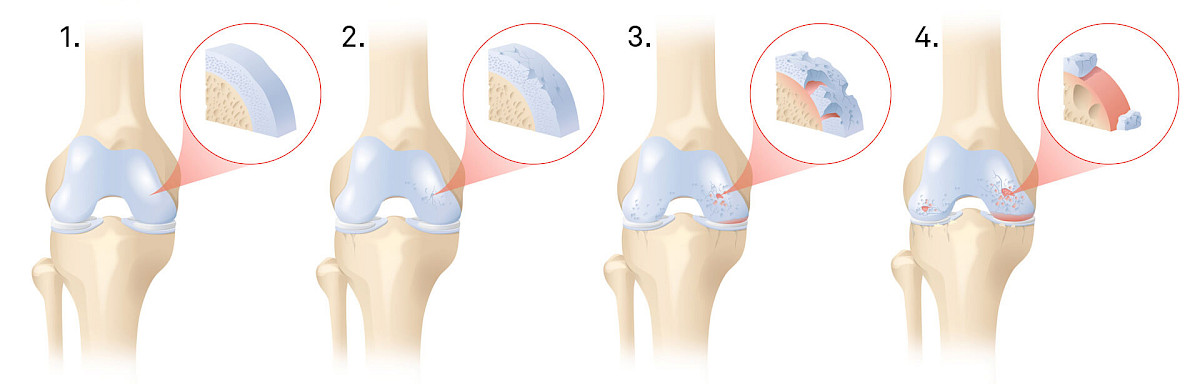 Illustration des 4 stades de lésion du cartilage